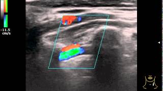 Linear probe, pulsating blood flow mapping mode.