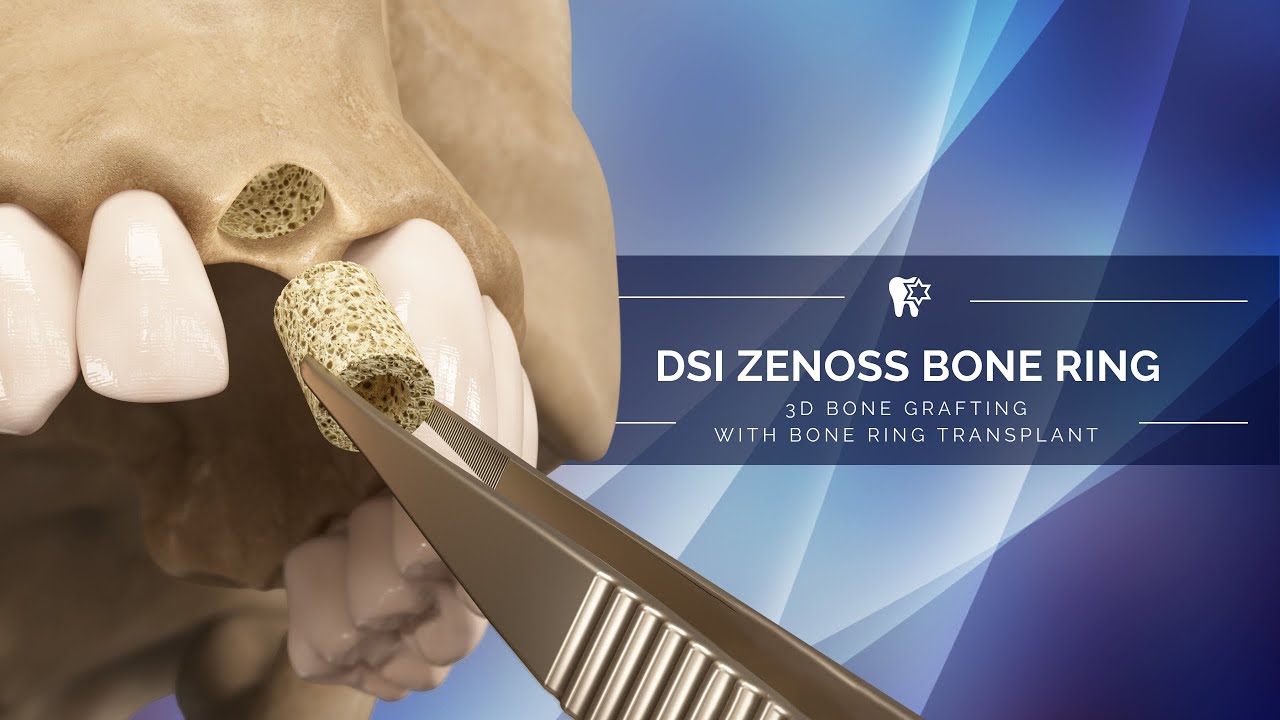 DSI Sponge ZenGraft Bone Plugs for Ridge Grafting 100% Bovine