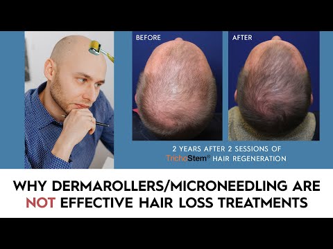 Derma Roller - Hair loss & hair growth therapy –