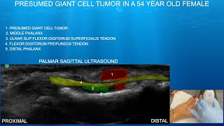 Ultrasound of a Presumed Giant Cell Tumor in the Index Finger Flexor Tendon Sheath. screenshot 5
