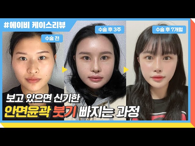 [윤곽3종+코성형] 에이비 케이스리뷰🎬 안면윤곽수술 후 부기가 빠지고 자리잡아가는 과정🕘