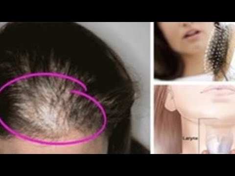 Wideo: Wypadanie Włosów U Kobiet: Przyczyny, Objawy, Leczenie