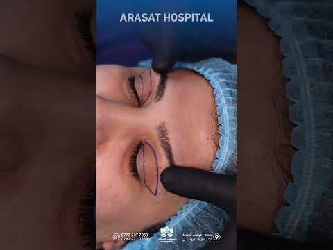 قص الاجفان بيد كادر ايراني متخصص مستشفى العرصات الاهلي تجميل