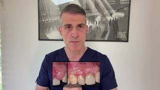 3 most common ways to get rid of black triangles