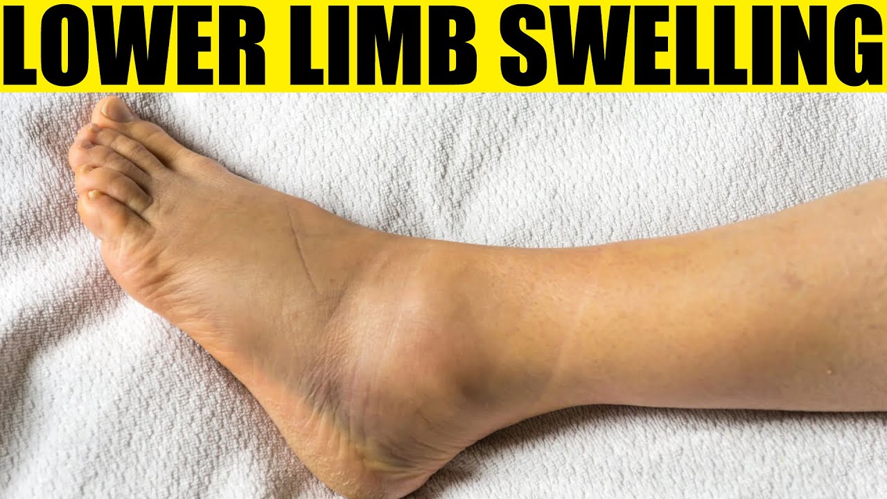 what-causes-swelling-of-the-feet-swelling-of-the-feet-dr-ashish