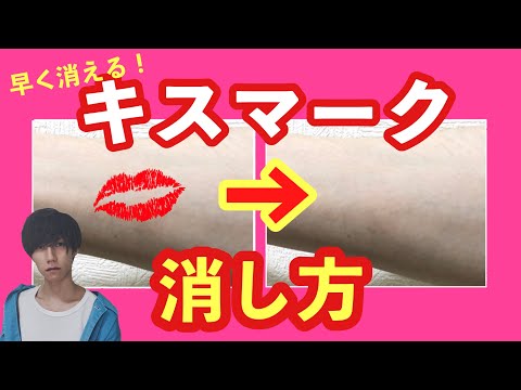 大人の自由研究 キスマークが ある方法 で魔法のように消えたんだがww Youtube