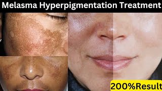 How To Treat Melasma at Home | Remove Hyperpigmentation, Melasma and Freckles | Result In 1 Week