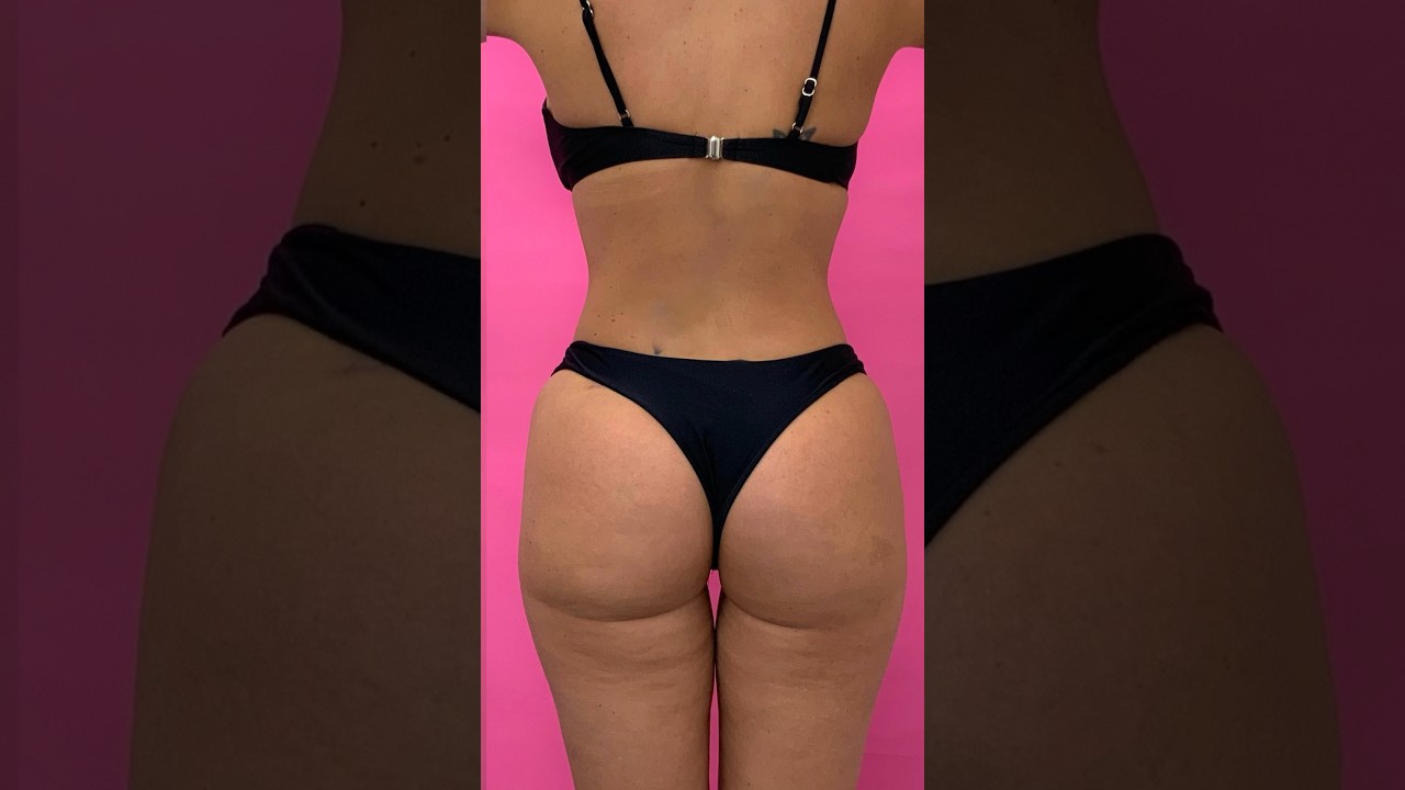 Natural Skinny BBL Results 