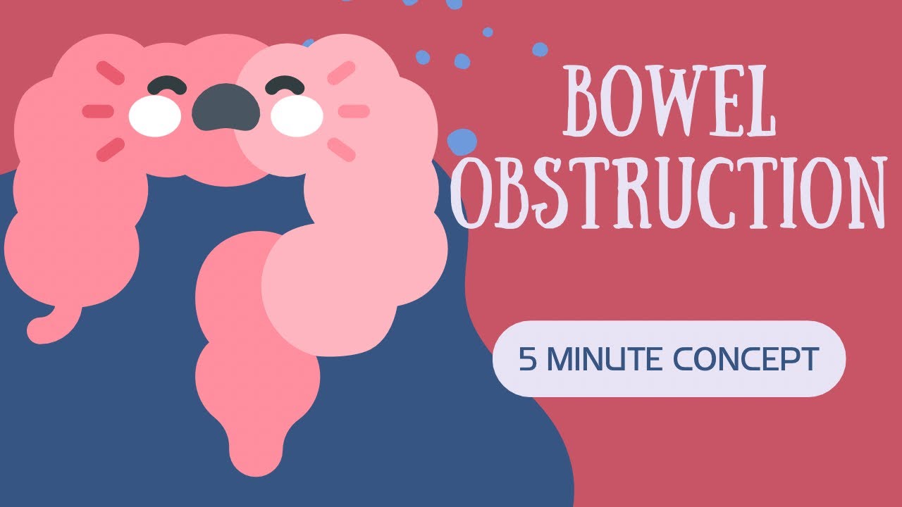 Bowel Obstruction Signs and Symptoms in Urdu/Hindi 5 minute concept