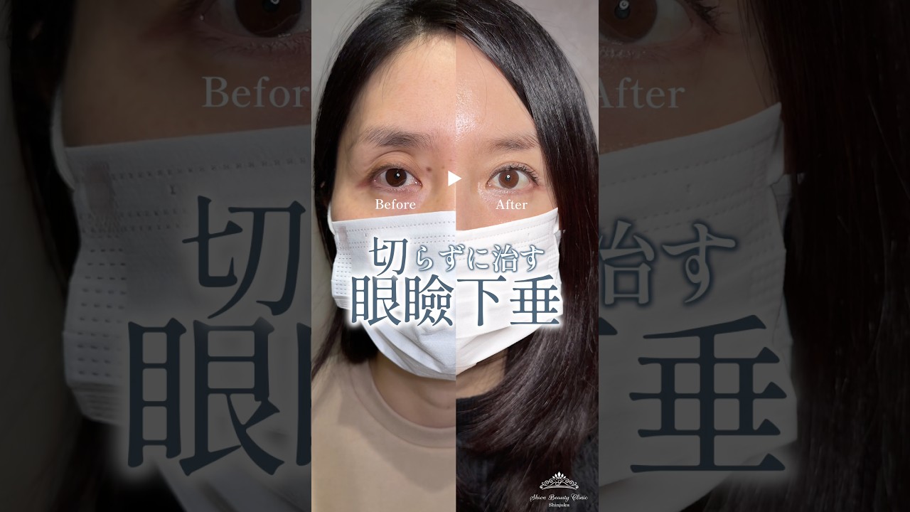 Double Eyelid Thread Lift × Incisionless Ptosis Correction
