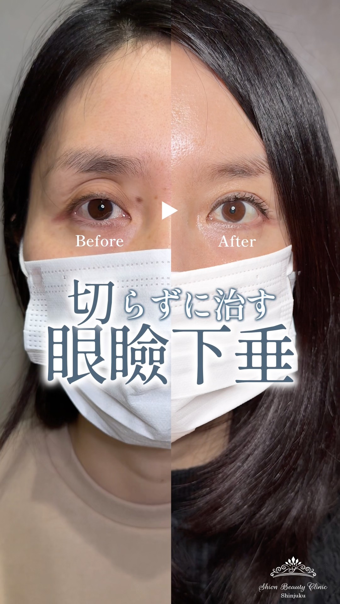 Double Eyelid Thread Lift × Incisionless Ptosis Correction