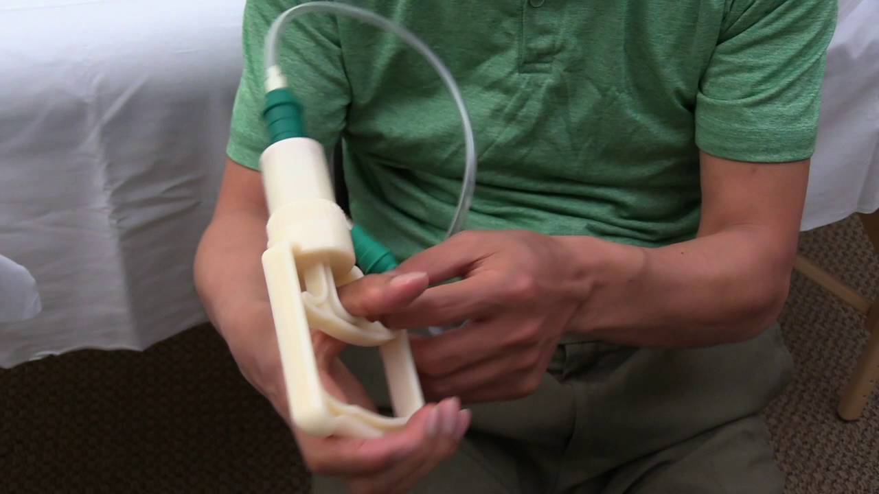 Chinese Cupping Therapy to Relieve Elbow Pain at Home YouTube