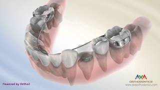 Orthodontic Space Management - Lingual Arch Appliance