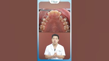 Kéo Răng Ngầm Khi Niềng Răng Có Đau Không | Nha Khoa Minh Châu