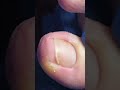 Ingrown Toenail Causing You Pain? See How We Bring Instant Relief! 😣 #feet #feets