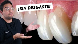 CARILLAS DENTALES: LO QUE NADIE TE DICE ¿PORQUE NO DESGASTAR? ¿TE QUEDAS SIN DIENTES?