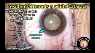 CataractCoach 1119: resident attempts a white cataract for case 50