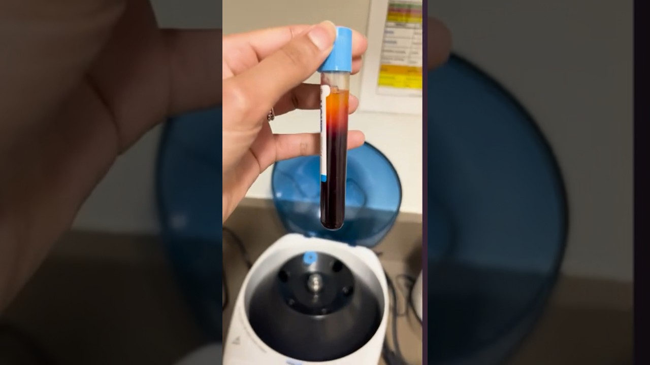 PRF от кругов под глазами — как это делается? 