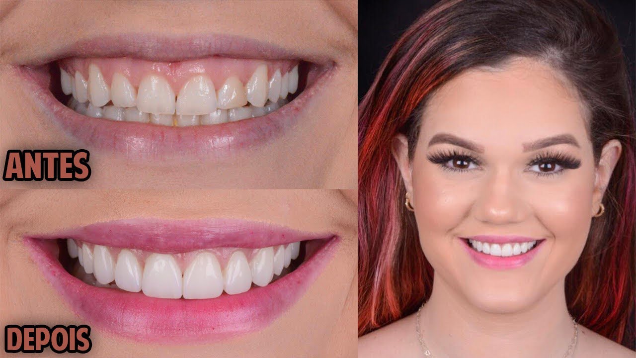 COLOQUEI LENTES DE CONTATO NOS DENTES! *o processo de verdade* - YouTube