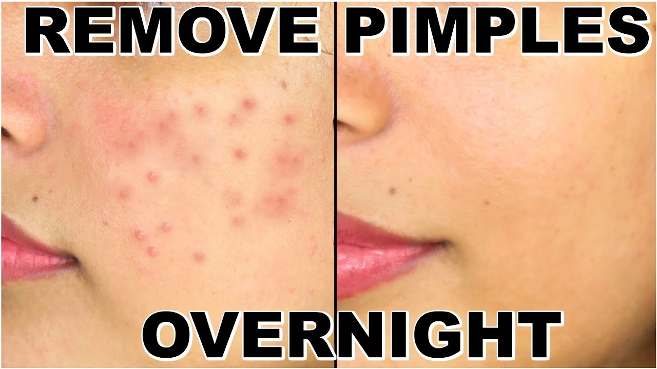 Images Special Varieties Of Acne  How To Deal With Them