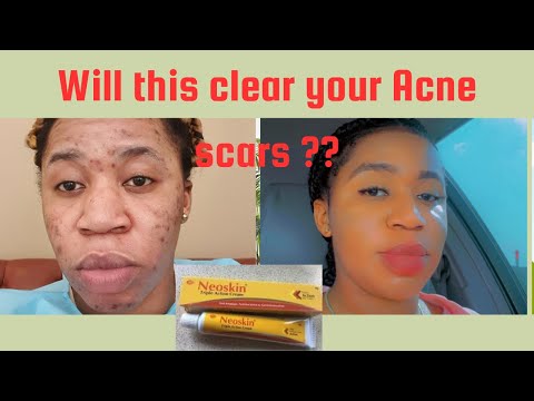How Much Is Neoskin Cream In Nigeria