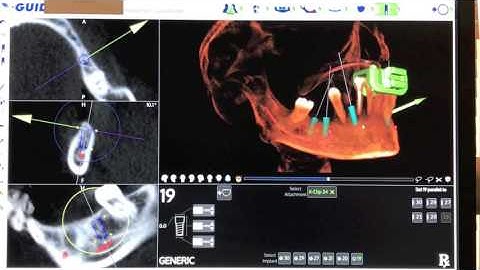 X GUIDE DENTAL IMPLANT SURGERY