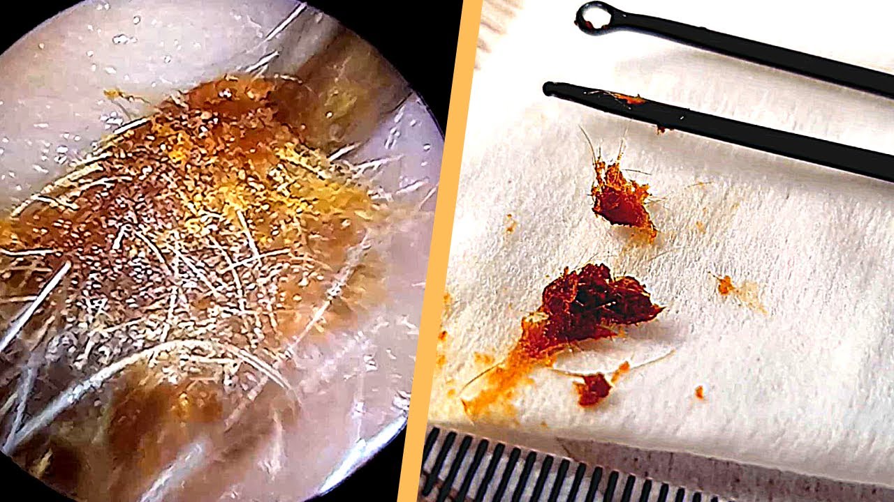 Hair Ball Stuck in Ear Extracted with Probes and Suction YouTube