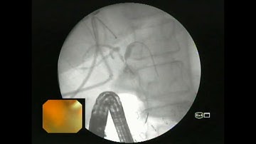 Endoscopic management of Post Cholecystectomy biliary stricture with bile leak