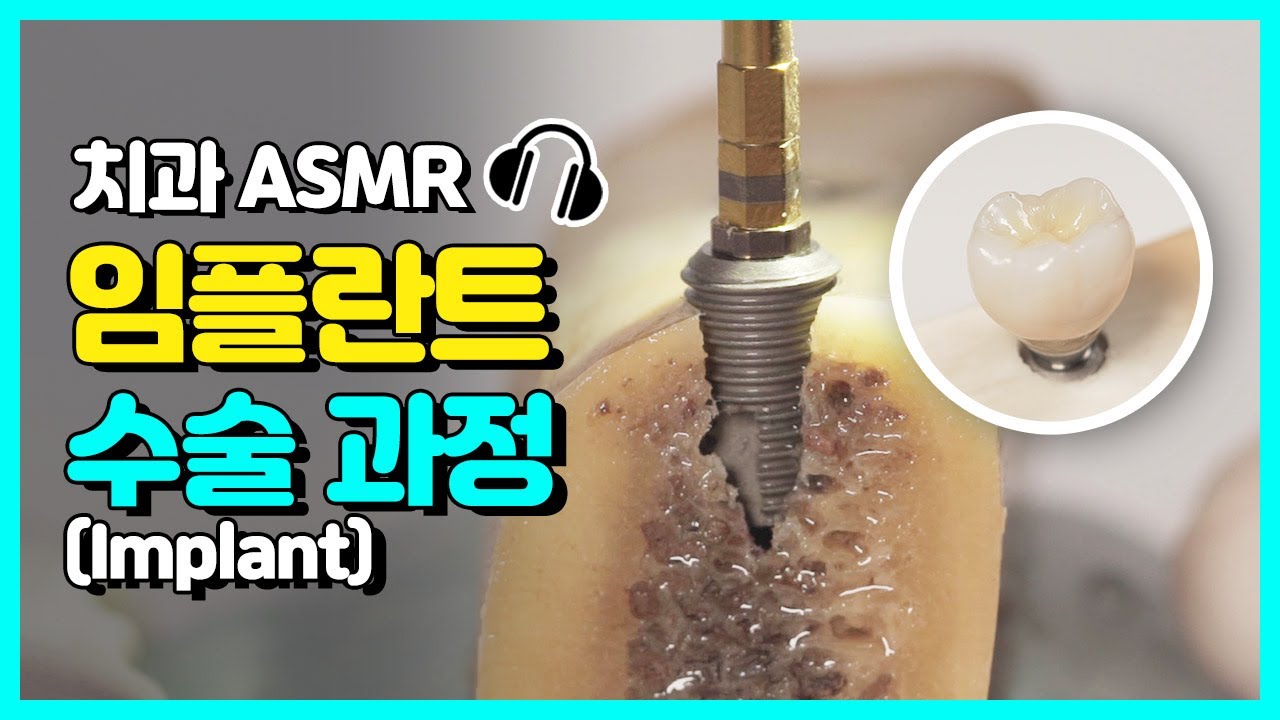 잇몸에 나사를?! 진짜 임플란트 식립 과정 공개 | 고품격 치과 ASMR | 당신이 아~ 한 사이에