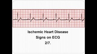 EKG a 3 fokozatú magas vérnyomás esetén ha a stressz miatti magas vérnyomás