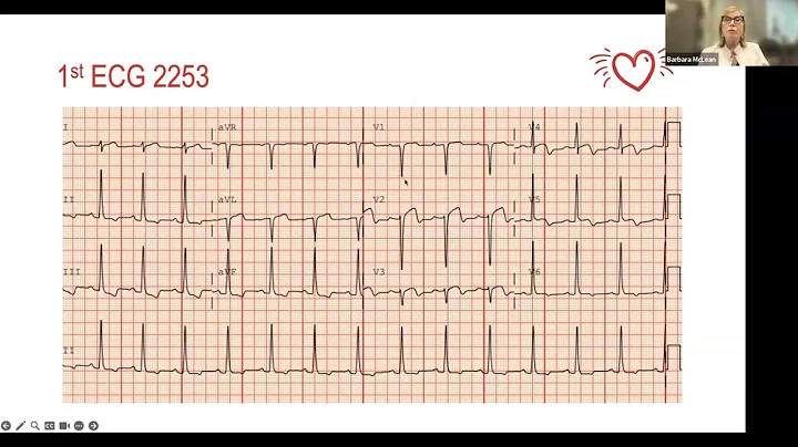 Missed STEMI wellens syndrome