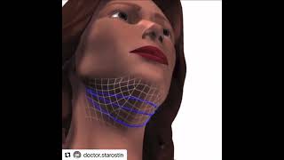 Aptos Thread Face Lift Sydney, Wahroonga & Canberra Cosmetic Clinics by Dr Beaini PH 1300885808 Aptos Thread Face Lift Sydney, Wahroonga & Canberra Cosmetic Clinics by Dr Beaini PH 1300885808