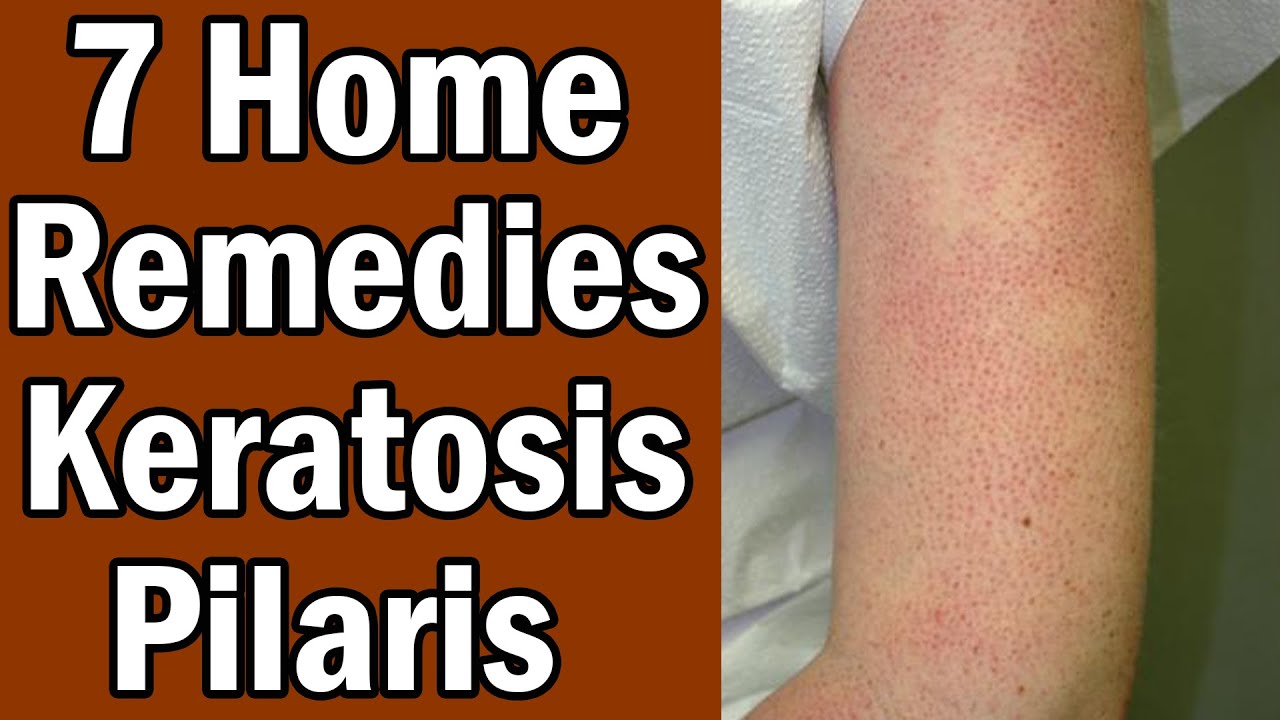 14 Home Remedies To Treat Keratosis Pilaris Bumps On The Skin Keratosis ...