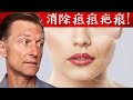 【皮膚】消除痘痘疤痕的最好方法,自然療法,柏格醫生 Dr Berg