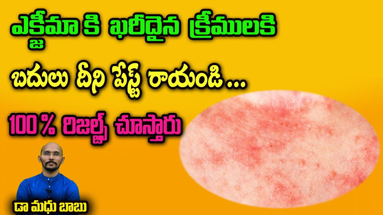 ఎక్జీమా కి ఖరీదైన క్రీములకి బదులు దీని పేస్ట్ రాయండి | Eczema treatment| Dr.Madhu Babu Health Trends