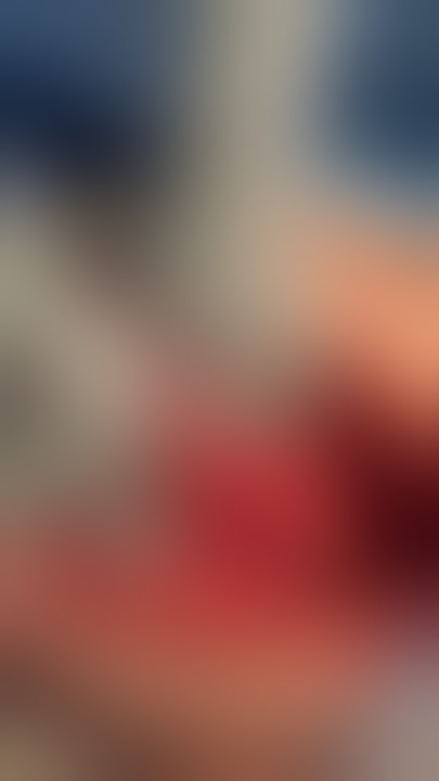 Correction of twisted ileal pouch-anal anastomosis (Graphic)