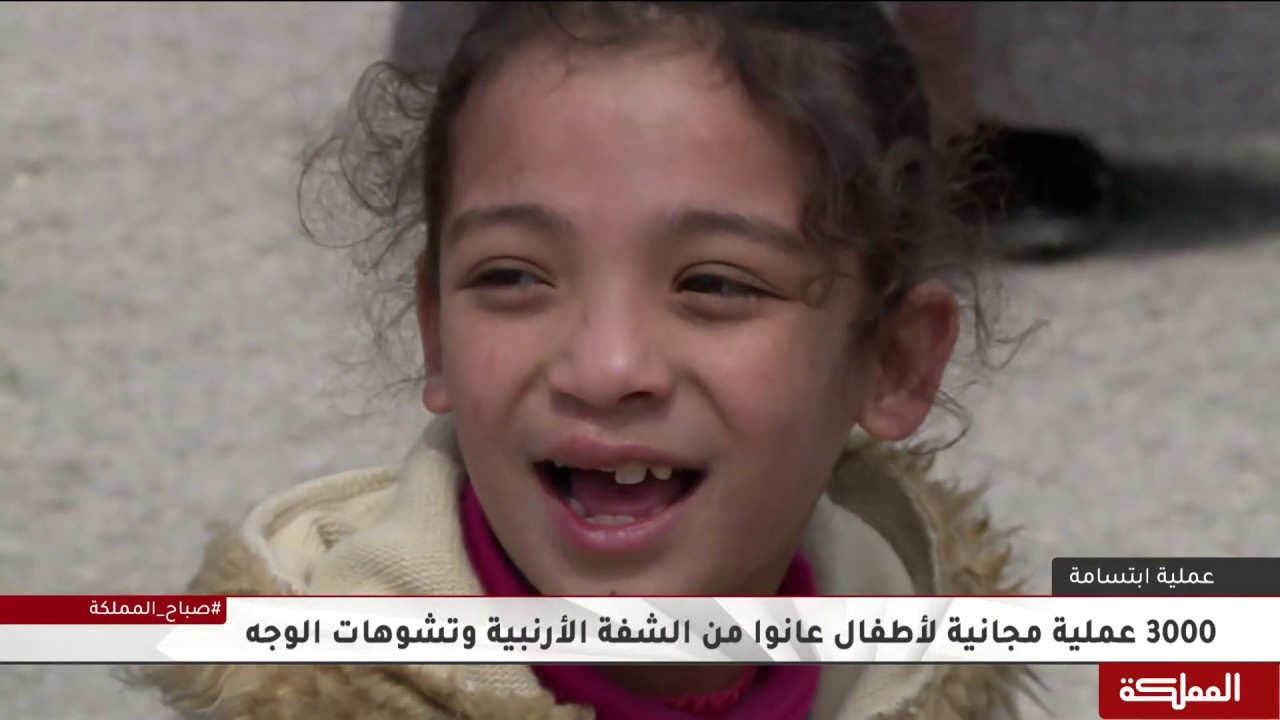 فرق طبية من الأردن والعالم لتقديم خدماتها للأطفال الذين يعانون من الشفة الارنبية