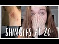 Getting Shingles At 20 Years Old