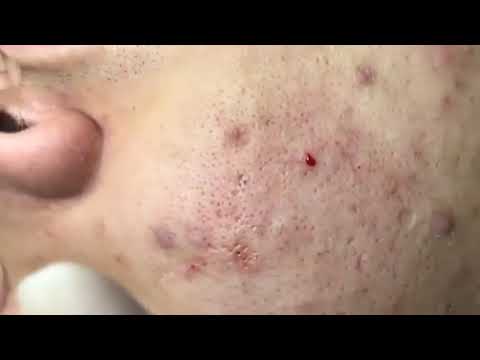 (AMAZING) !!! BEST BLACKHEAD REMOVE AND CYSTIC  REMOVE ON FACE (PART )