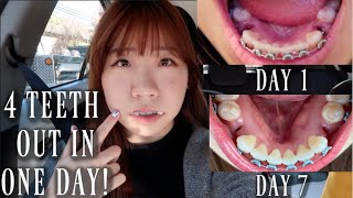 4 PREMOLARS EXTRACTED IN ONE DAY! (ONE WEEK HEALING PROCESS VLOG) | Adult Braces