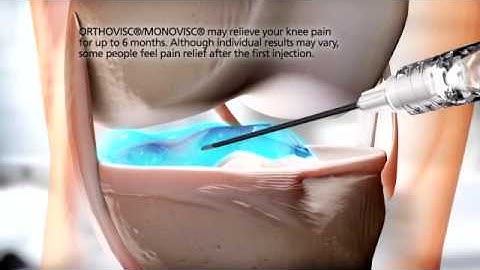 Orthovisc Monovisc Depuy Synthes Animation Video