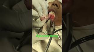 Apicoectomy  of lower central incisors  #incisor #teeth #treatment #cyst #awarenessvideo #follow