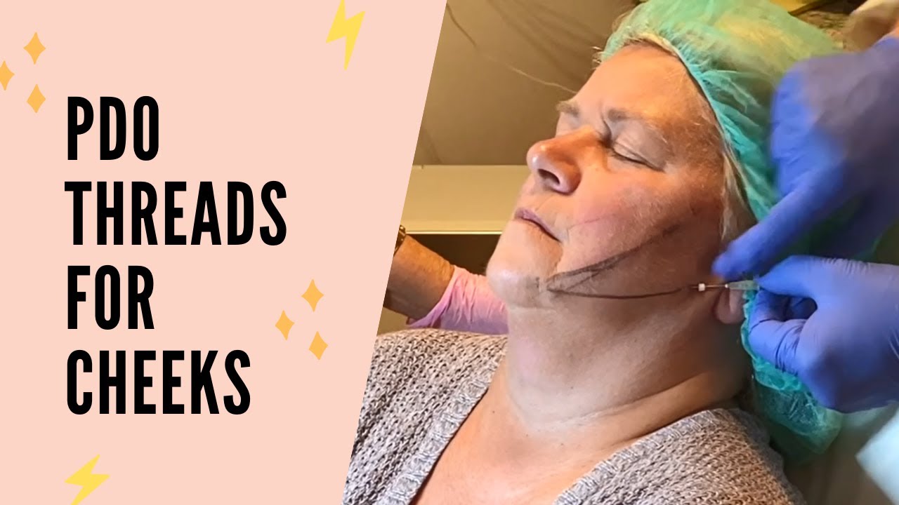 PDO Threads for Cheeks | Part 1 of PDO Threads - YouTube