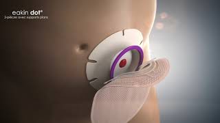 eakin dot®  2-pièces avec supports plans  (Clinical)