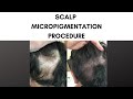Scalp Micropigmentation at Parsa Mohebi ✨