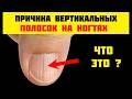 Вертикальные Борозды на Ногтях – Что Они Значат и Когда Это Опасно
