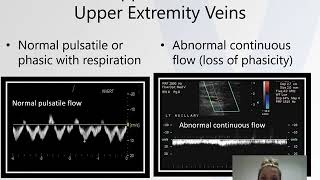 Technical Tip Tuesday Case Study - Upper Extremity Venous Thrombosis