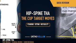 The Hip-Spine Relationship in THA — A Moving Cup Target — Quick Revision (clinical review)