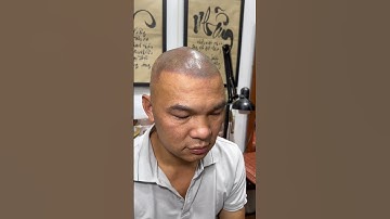 Before and after  Smp Scalp vietnam by Tuấn Ori #xămtóc #hói_đầu #reviewxămtóc #scalp #scalpvn