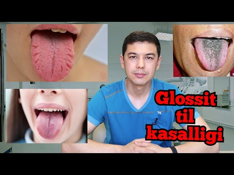 Glossit til kasalligi.      ГЛОССИТ ТИЛ КАСАЛЛИГИ